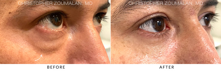 Lower Lid Blepharoplasty Before & After Photo - Patient Seeing Side - Patient 8C