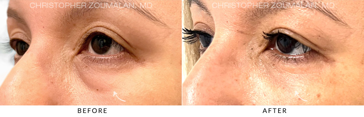 Lower Lid Blepharoplasty Before & After Photo - Patient Seeing Side - Patient 7C