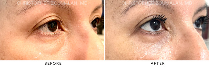 Lower Lid Blepharoplasty Before & After Photo - Patient Seeing Side - Patient 7D