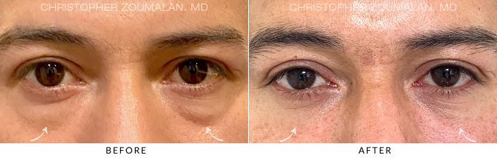 Lower Lid Blepharoplasty Before & After Photo - Patient Seeing Straight - Patient 3A