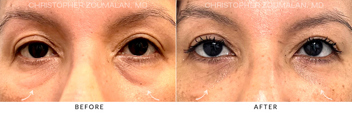 Lower Lid Blepharoplasty Before & After Photo - Patient Seeing Straight - Patient 7A