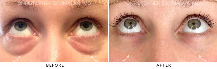 Lower Lid Blepharoplasty Before & After Photo - Patient Seeing Up - Patient 5B