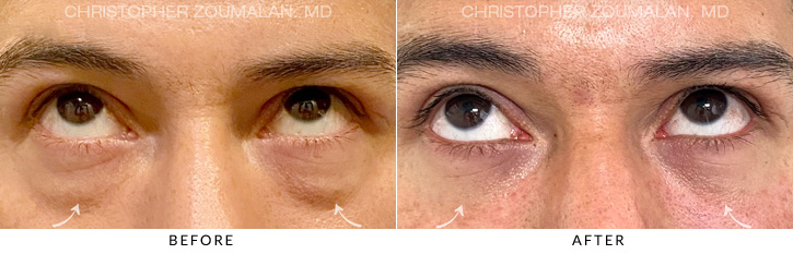 Lower Lid Blepharoplasty Before & After Photo - Patient Seeing Up - Patient 3B
