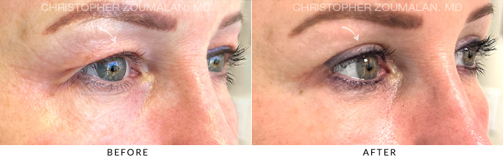 Upper Lid Blepharoplasty Before & After Photo - Patient Seeing Side - Patient 2B