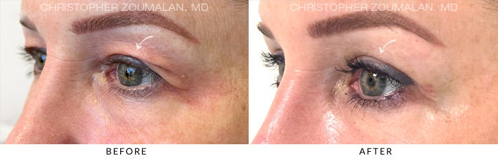 Upper Lid Blepharoplasty Before & After Photo - Patient Seeing Side - Patient 8C