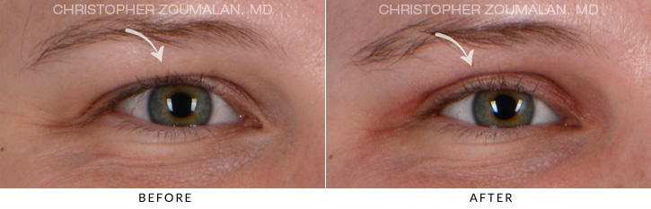 Upper Lid Blepharoplasty Before & After Photo - Patient Seeing Straight - Patient 1A