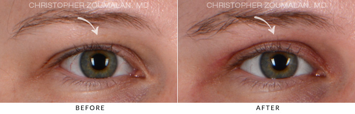 Upper Lid Blepharoplasty Before & After Photo - Patient Seeing Straight - Patient 7B