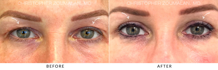 Upper Lid Blepharoplasty Before & After Photo - Patient Seeing Straight - Patient 8A