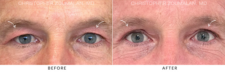 Male Blepharoplasty Before & After Photo - Patient Seeing Straight - Patient 4A