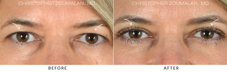 Upper Lid Blepharoplasty Before & After Photo - Patient Seeing Straight - Patient 4A