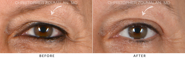 Upper Lid Blepharoplasty Before & After Photo - Patient Seeing Straight - Patient 7A