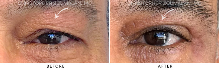 Upper Lid Blepharoplasty Before & After Photo - Patient Seeing Straight - Patient 10A
