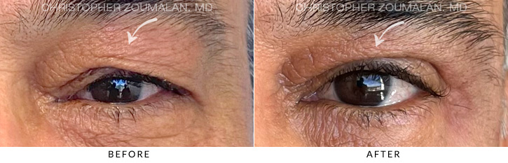 Upper Lid Blepharoplasty Before & After Photo - Patient Seeing Straight - Patient 16A