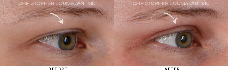 Upper Lid Blepharoplasty Before & After Photo - Patient Seeing Side - Patient 1C