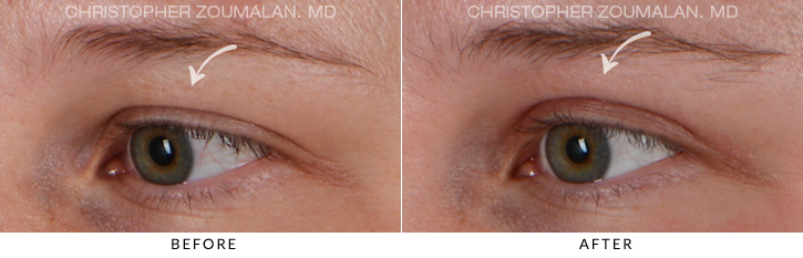 Upper Lid Blepharoplasty Before & After Photo - Patient Seeing Side - Patient 1D