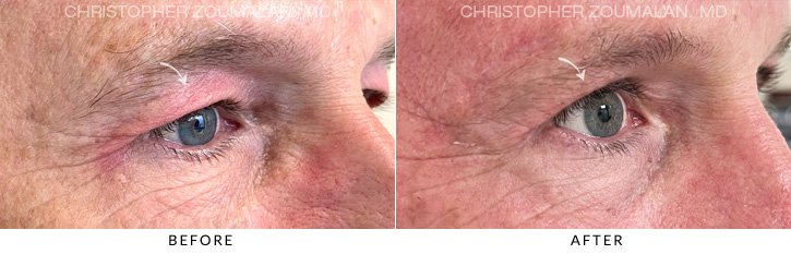 Upper Lid Blepharoplasty Before & After Photo - Patient Seeing Side - Patient 3B