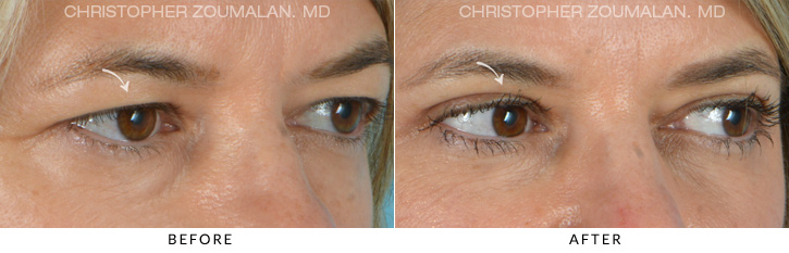 Upper Lid Blepharoplasty Before & After Photo - Patient Seeing Side - Patient 10B
