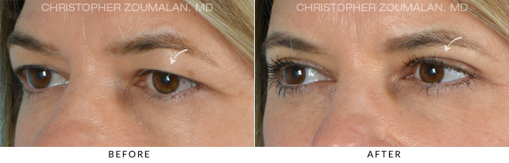 Upper Lid Blepharoplasty Before & After Photo - Patient Seeing Side - Patient 10C