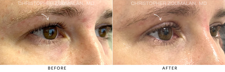 Upper Lid Blepharoplasty Before & After Photo - Patient Seeing Side - Patient 11B