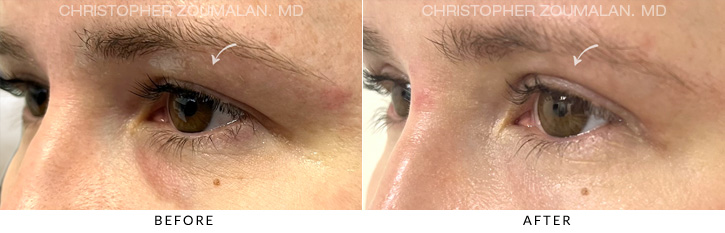 Upper Lid Blepharoplasty Before & After Photo - Patient Seeing Side - Patient 11C