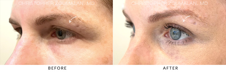 Endoscopic Brow Lift Before & After Photo - Patient Seeing Side - Patient 2B