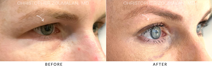 Endoscopic Brow Lift Before & After Photo - Patient Seeing Side - Patient 2C