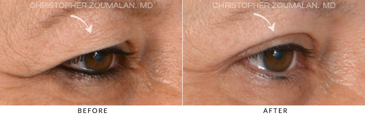 Upper Lid Blepharoplasty Before & After Photo - Patient Seeing Side - Patient 13C