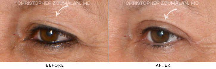 Upper Lid Blepharoplasty Before & After Photo - Patient Seeing Side - Patient 7B