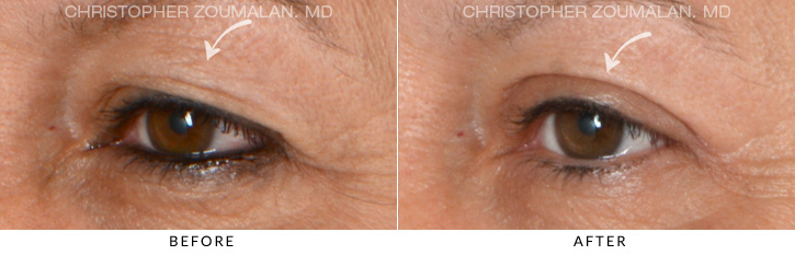 Upper Lid Blepharoplasty Before & After Photo - Patient Seeing Side - Patient 13B