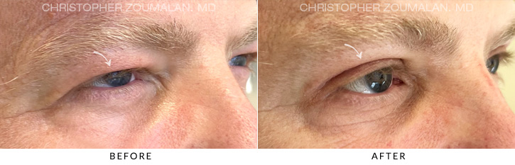 Upper Lid Blepharoplasty Before & After Photo - Patient Seeing Side - Patient 9B