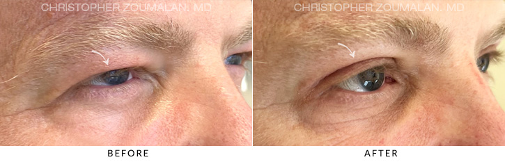 Upper Lid Blepharoplasty Before & After Photo - Patient Seeing Side - Patient 15B