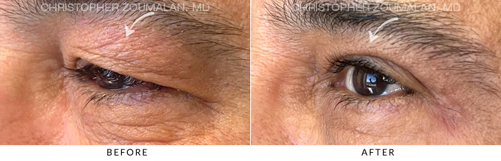 Upper Lid Blepharoplasty Before & After Photo - Patient Seeing Side - Patient 10B