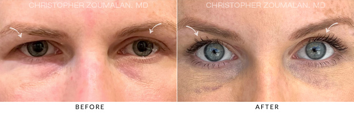 Endoscopic Brow Lift Before & After Photo - Patient Seeing Straight - Patient 1A
