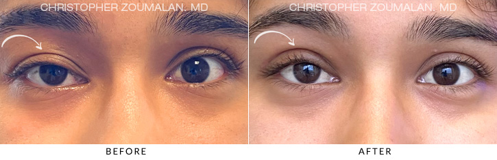 Ptosis Surgery Before & After Photo -  - Patient 2