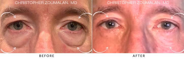 Male Blepharoplasty Before & After Photo - Patient Seeing Straight - Patient 3A