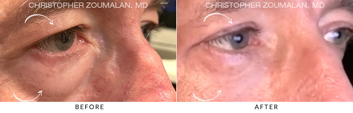 Male Blepharoplasty Before & After Photo - Patient Seeing Side - Patient 1B