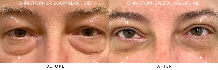 Quad Blepharoplasty Before & After Photo - Patient Seeing Straight - Patient 7A