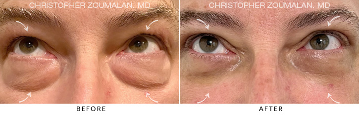 Quad Blepharoplasty Before & After Photo - Patient Seeing Up - Patient 3B