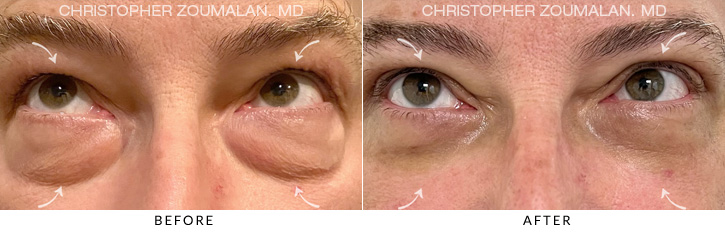 Quad Blepharoplasty Before & After Photo - Patient Seeing Up - Patient 7B