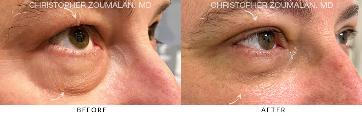 Quad Blepharoplasty Before & After Photo - Patient Seeing Side - Patient 7C