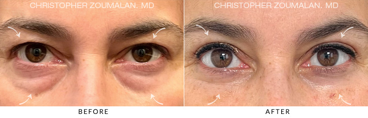 Quad Blepharoplasty Before & After Photo - Patient Seeing Straight - Patient 4A