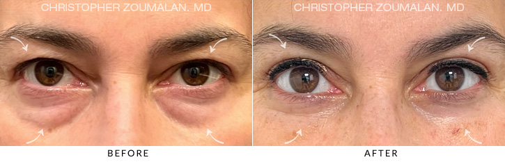 Quad Blepharoplasty Before & After Photo - Patient Seeing Straight - Patient 8A