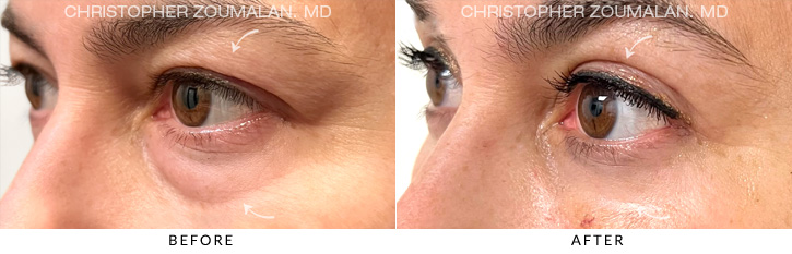 Quad Blepharoplasty Before & After Photo - Patient Seeing Side - Patient 4C