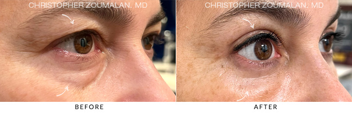 Quad Blepharoplasty Before & After Photo - Patient Seeing Side - Patient 4D