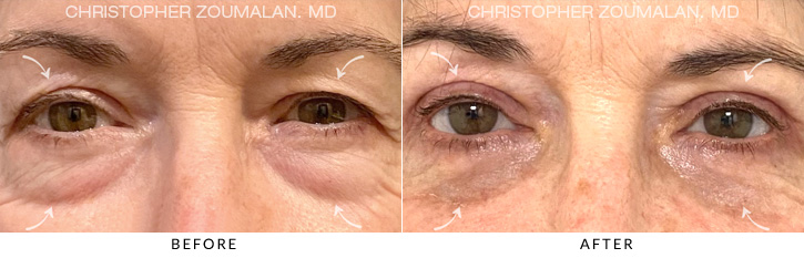Quad Blepharoplasty Before & After Photo - Patient Seeing Straight - Patient 5A