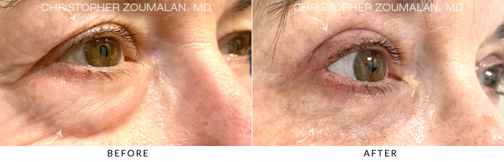 Quad Blepharoplasty Before & After Photo - Patient Seeing Side - Patient 5C