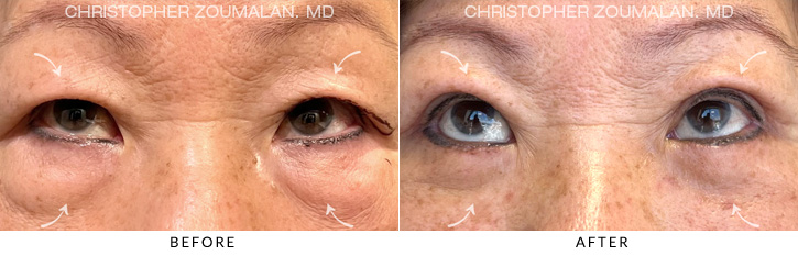 Quad Blepharoplasty Before & After Photo - Patient Seeing Up - Patient 6B