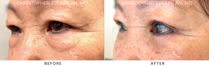 Quad Blepharoplasty Before & After Photo - Patient Seeing Side - Patient 6C