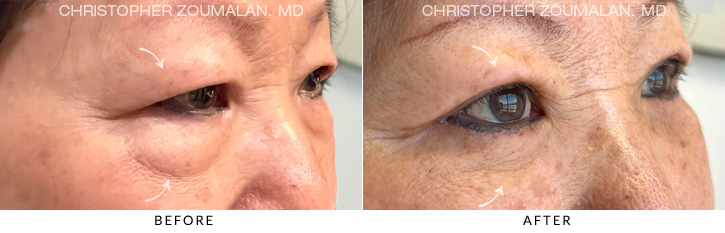 Quad Blepharoplasty Before & After Photo - Patient Seeing Side - Patient 6D