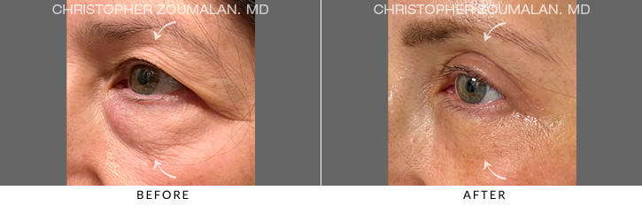 Quad Blepharoplasty Before & After Photo - Patient Seeing Side - Patient 1A